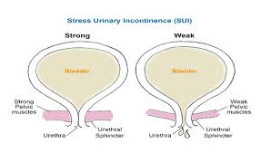 Recovery after pelvic floor surgery: practical tips